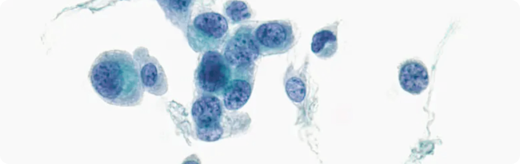 Bladder Cancer microscopy
